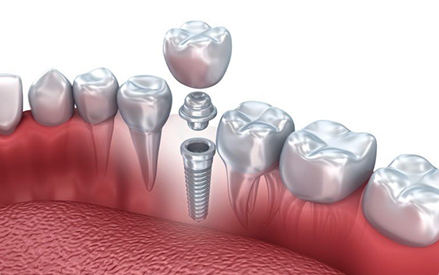 Perspectivele de dezvoltare ale materialelor medicale din titan.